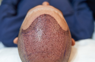 Hair restoration treatment in Nepal