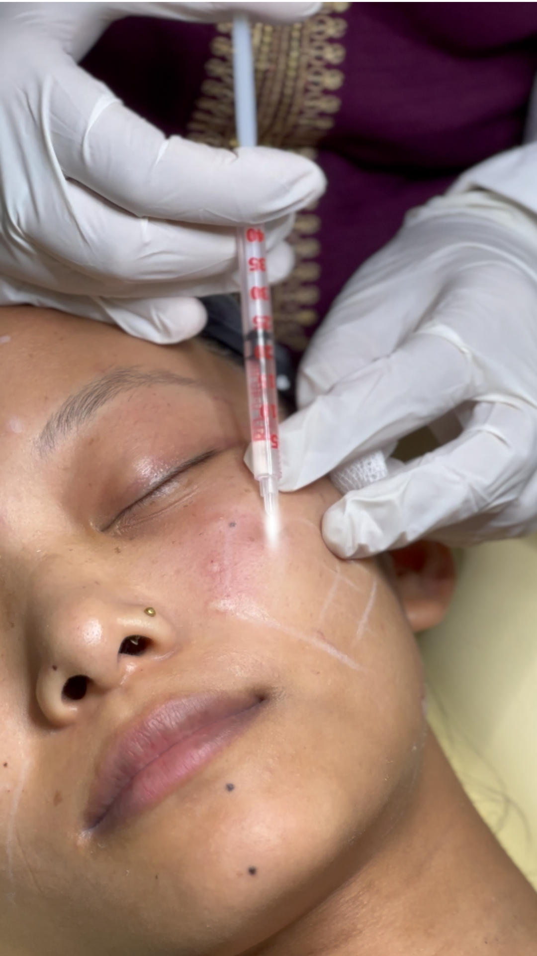 Botox treatment in Nepal