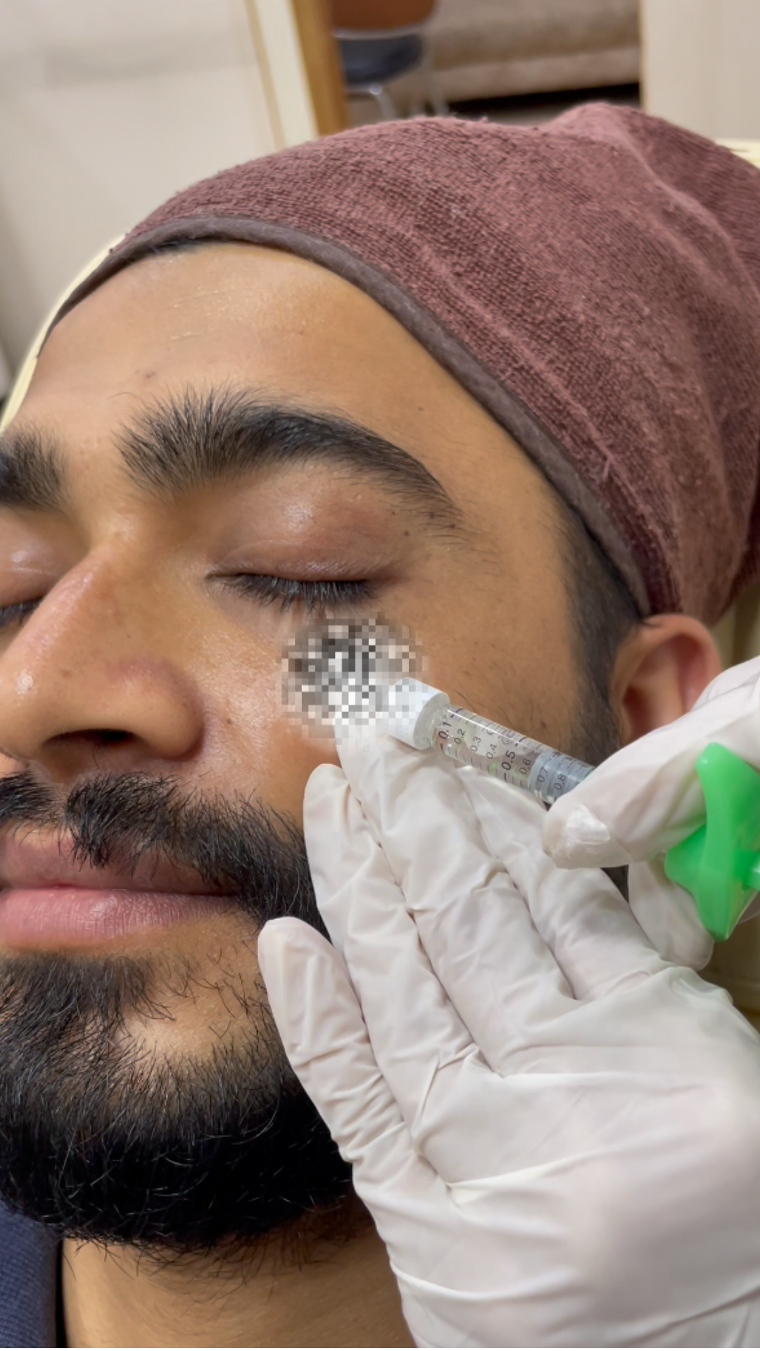 Dermal fillers in Nepal