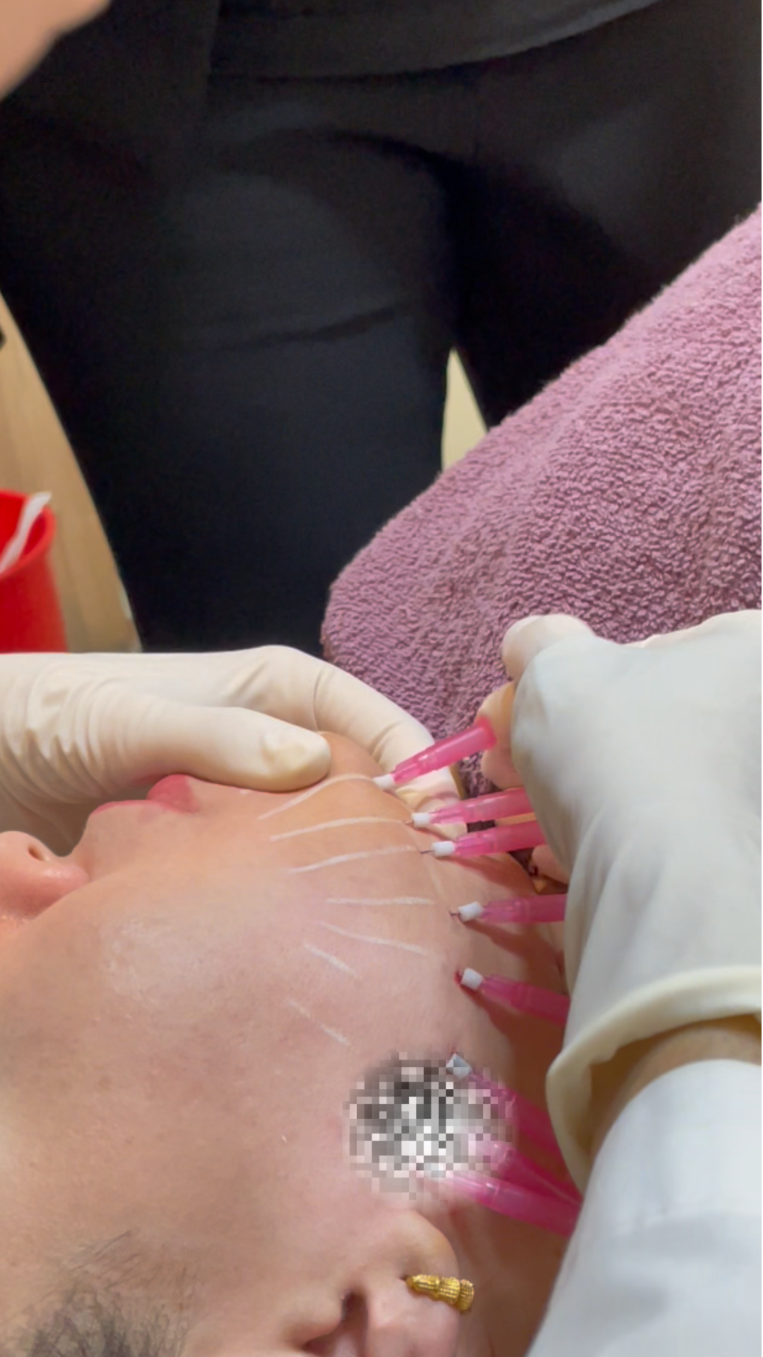 Thread lift treatment in Nepal