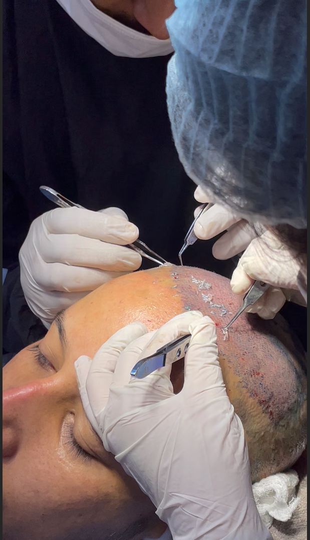 Hair transplant in Nepal