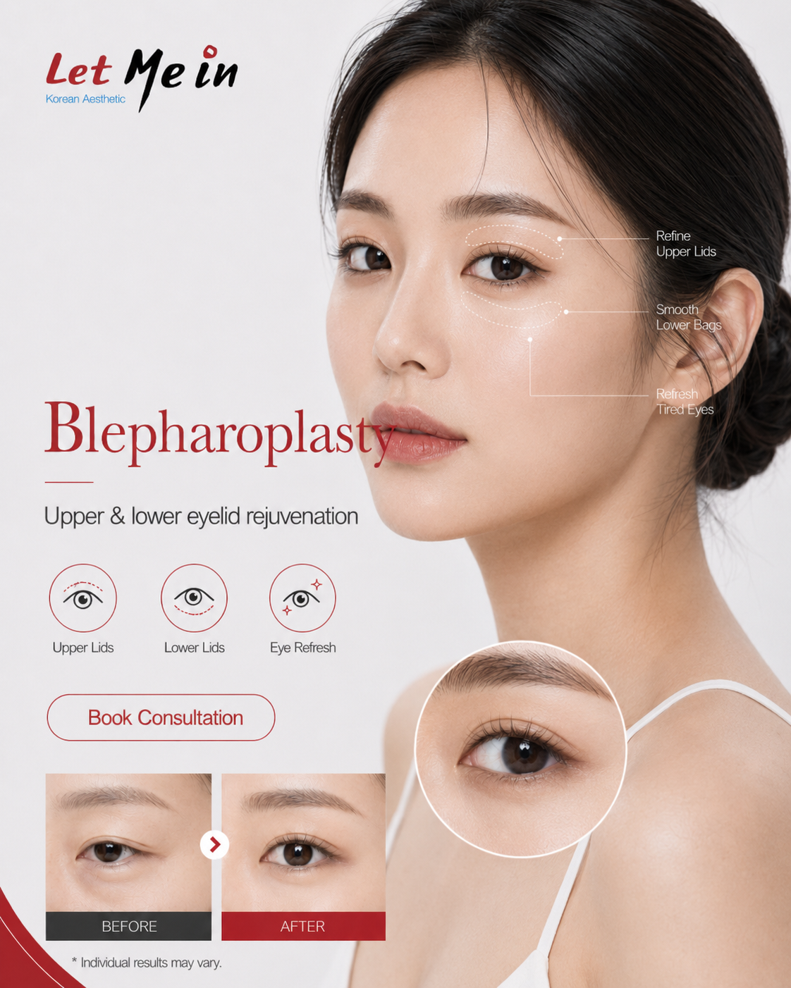 Blepharoplasty eyelid surgery in Nepal