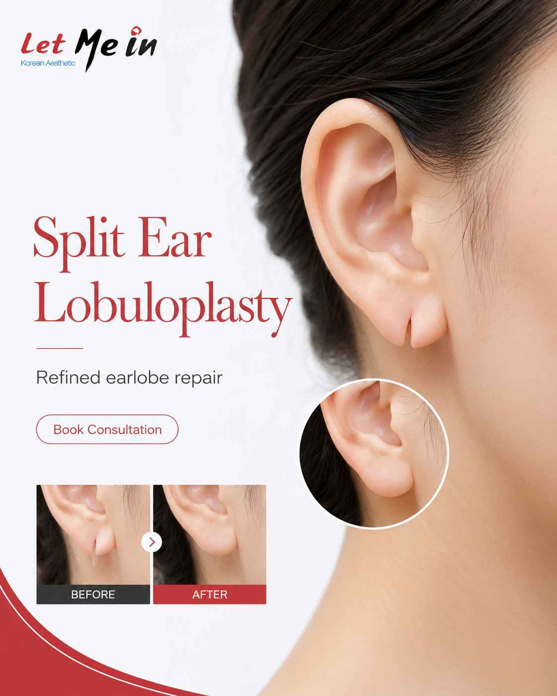 Split earlobe repair in Nepal