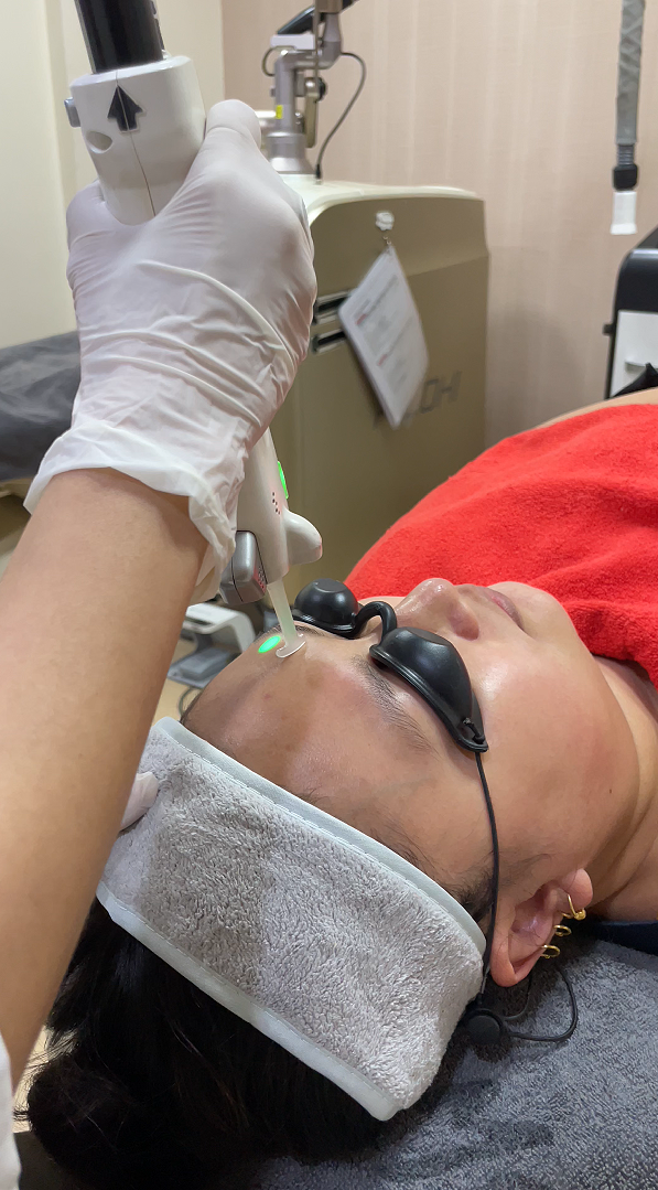 Laser toning treatment in Nepal