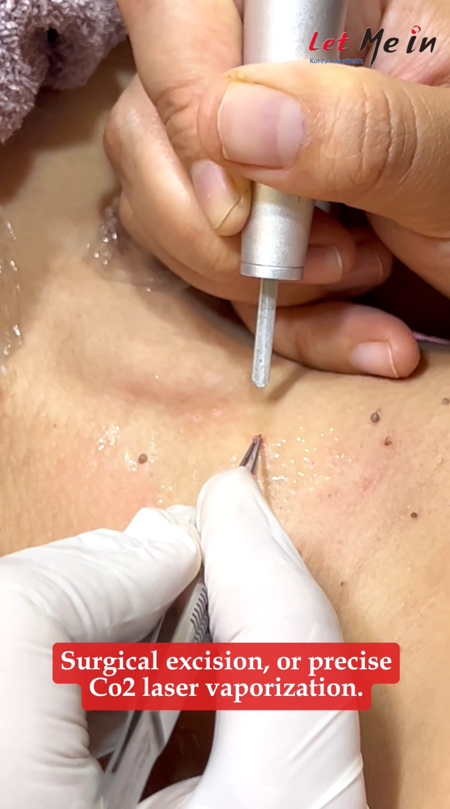 Skin tag removal in Nepal