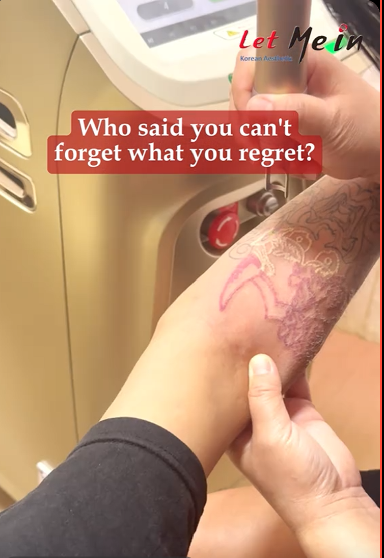 Tattoo removal laser treatment in Nepal